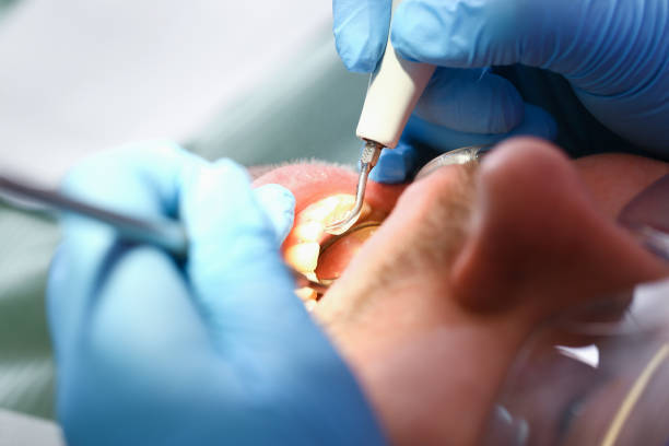 Best Emergency Tooth Extraction in Warrenvle, IL