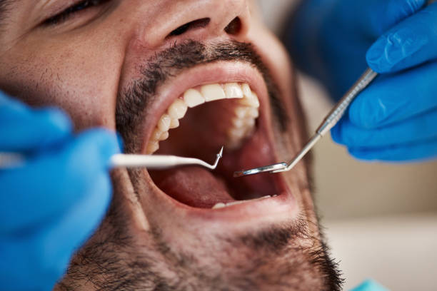 Best Emergency Wisdom Teeth Removal in Warrenvle, IL